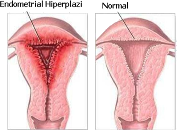 Endometrial Hiperplazi