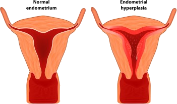 Endometrial Hiperplazi 2