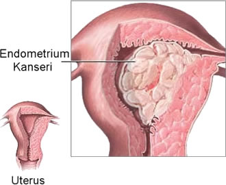 Endometrium (rahim iç zarı) kanseri
