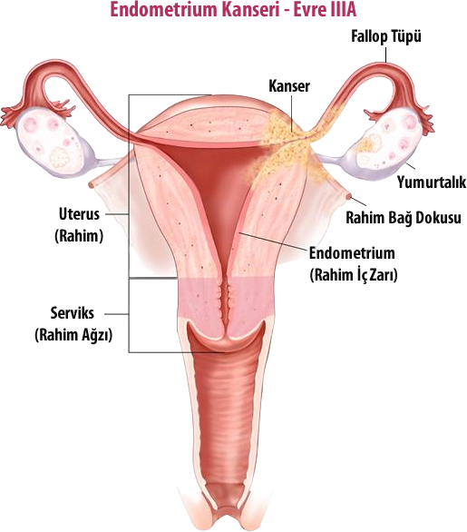 Endometrium kanseri evrelendirme görseli