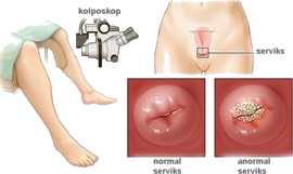 Kolposkopi 3