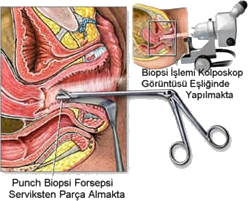 Kolposkopi Biyopsi