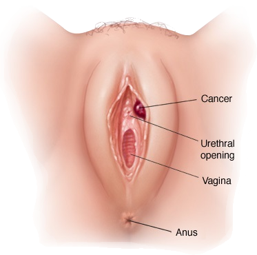 Vulva (dış genital bölge) kanseri görseli
