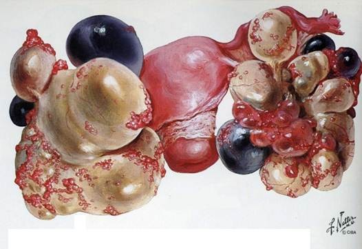 Yumurtalık Kanseri Ultrason