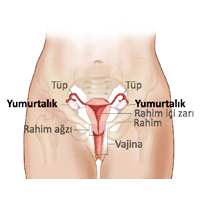 Yumurtalık Kanseri